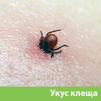 Укус клеща в Щёлково